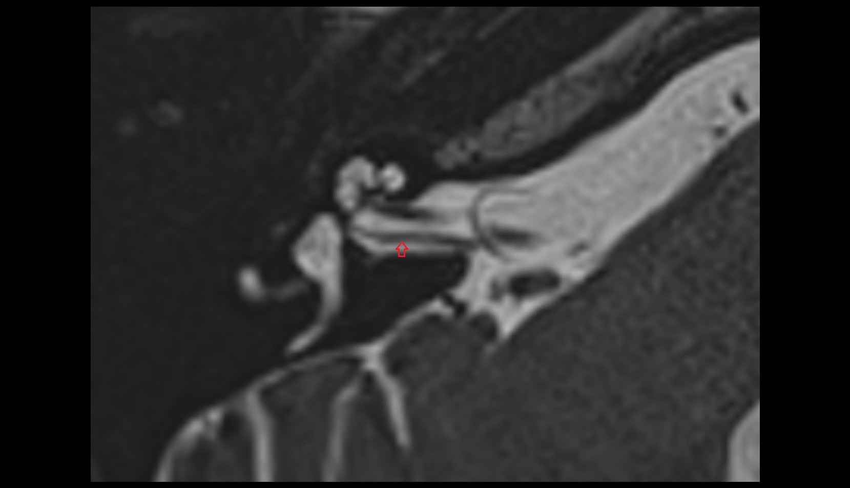 Inferior vestibular nerve MRI axial image 1