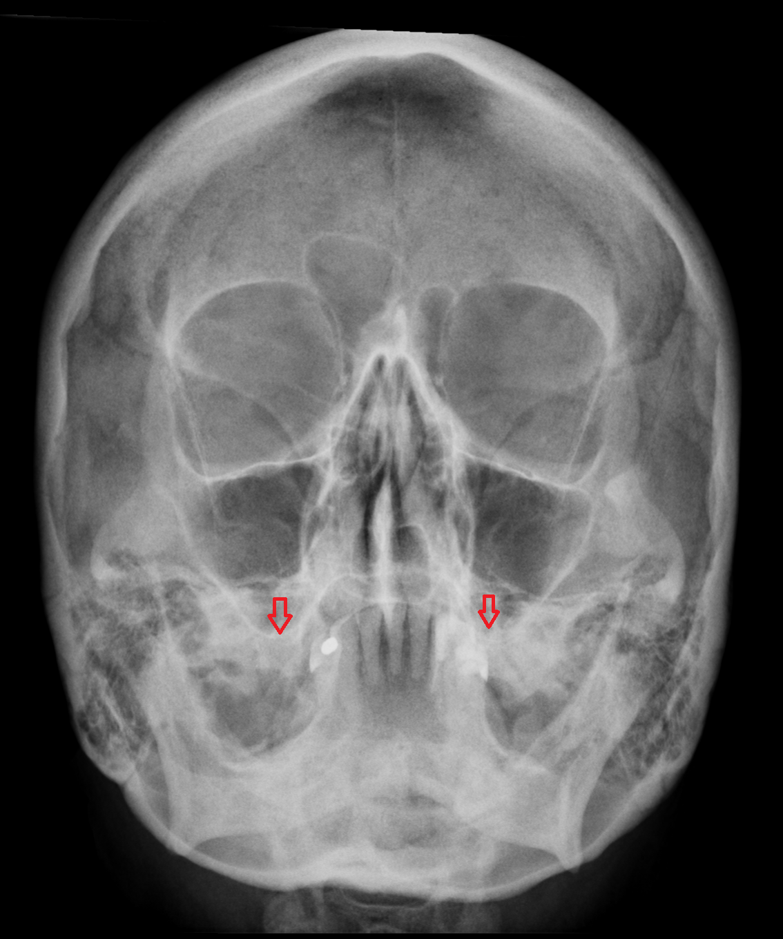 Inferior wall of maxillary sinus