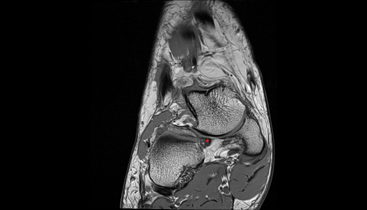 Inferoplantar longitudinal calcaneonavicular ligament  coronal cross sectional anatomy 3T MRI AI enhanced radiology image-img-00000-00000_00001