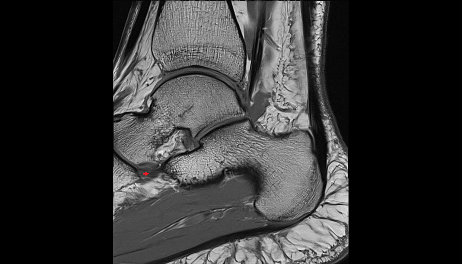 Inferoplantar longitudinal calcaneonavicular ligament  sagittal cross sectional anatomy 3T MRI AI enhanced radiology image-img-00000-00000