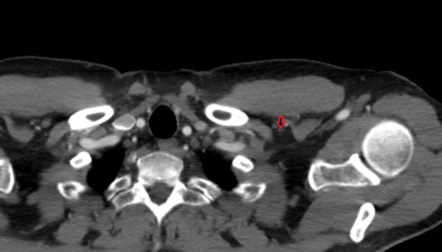 Infraclavicular lymph nodes  anatomy  CT axial image -img-00000-00000