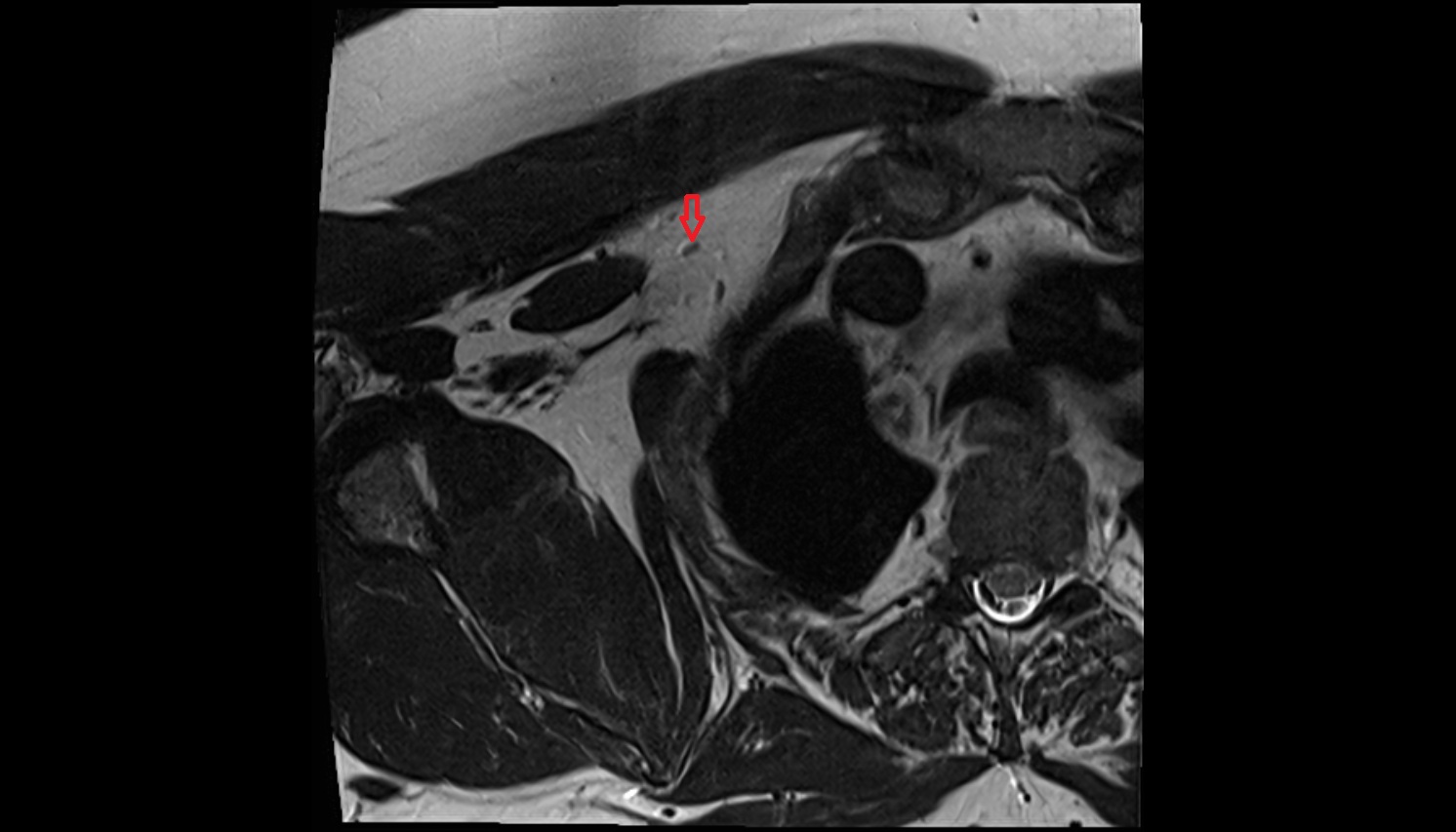 Infraclavicular lymph nodes  anatomy  mri axial image -img-00000-00000