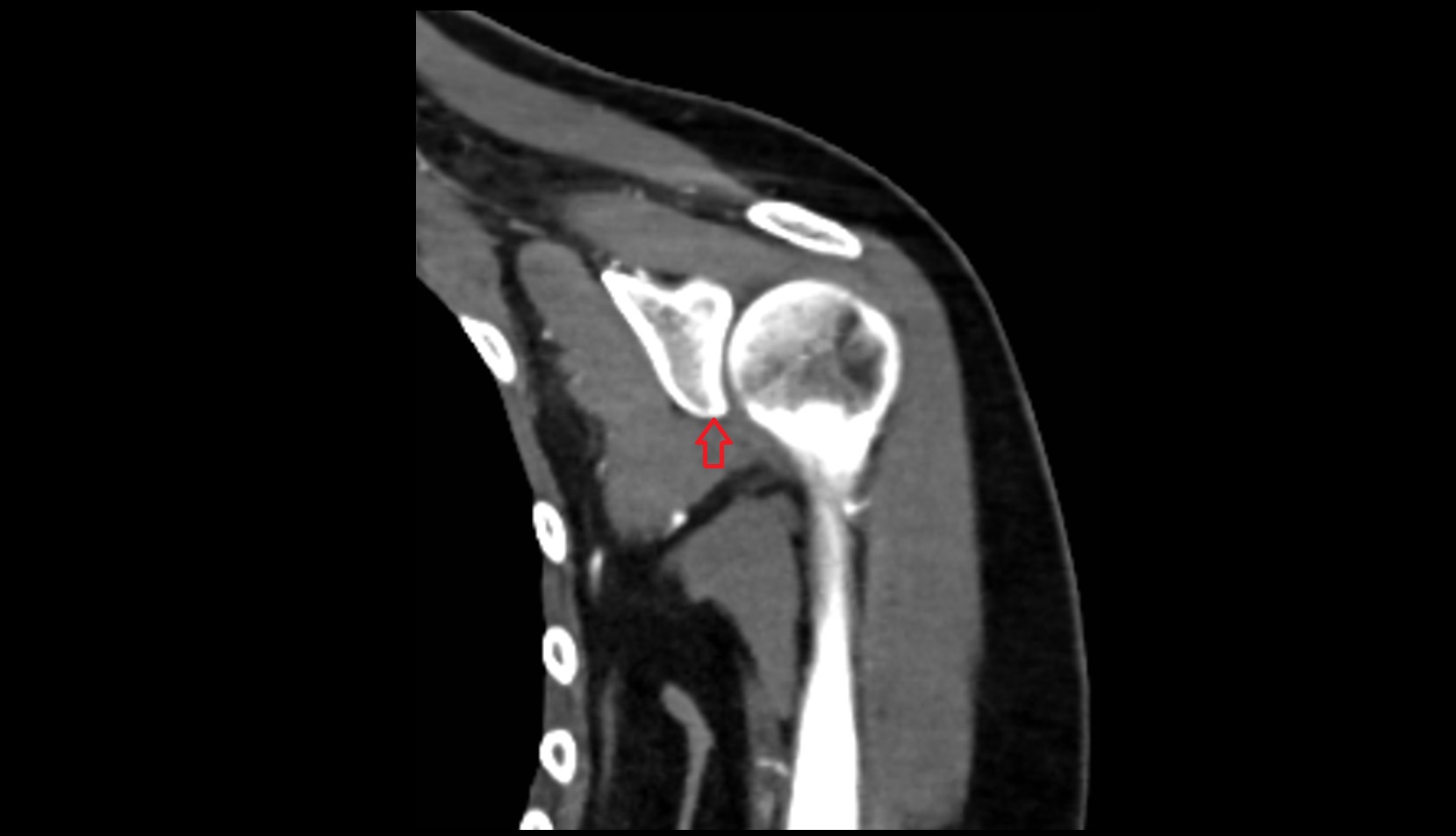 Infraglenoid tubercle ct