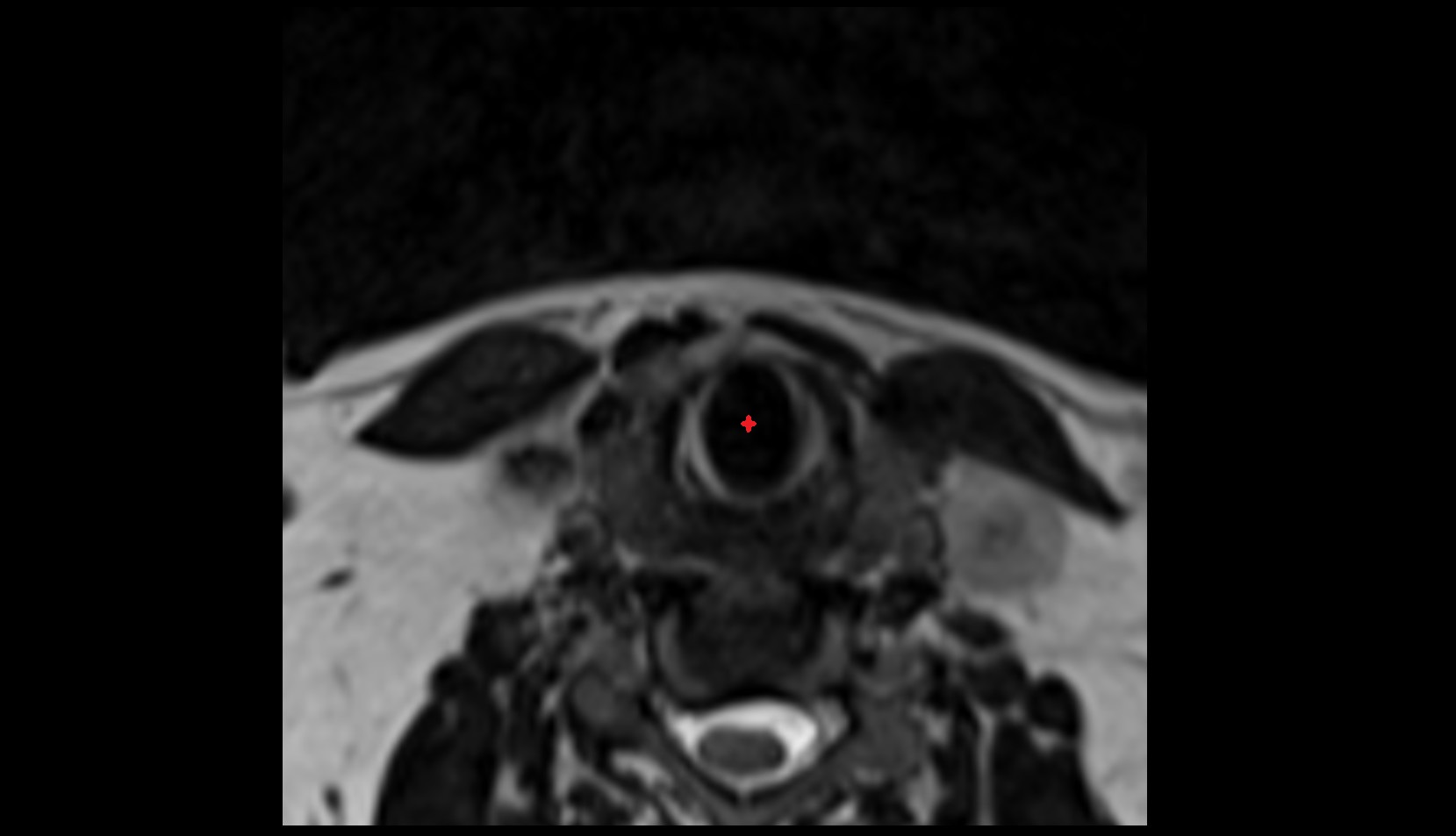 Infraglottic cavity MRI axial image