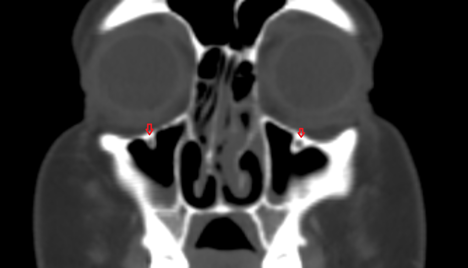 Infraorbital canal  CT  anatomy labelled image-img-00000-00000