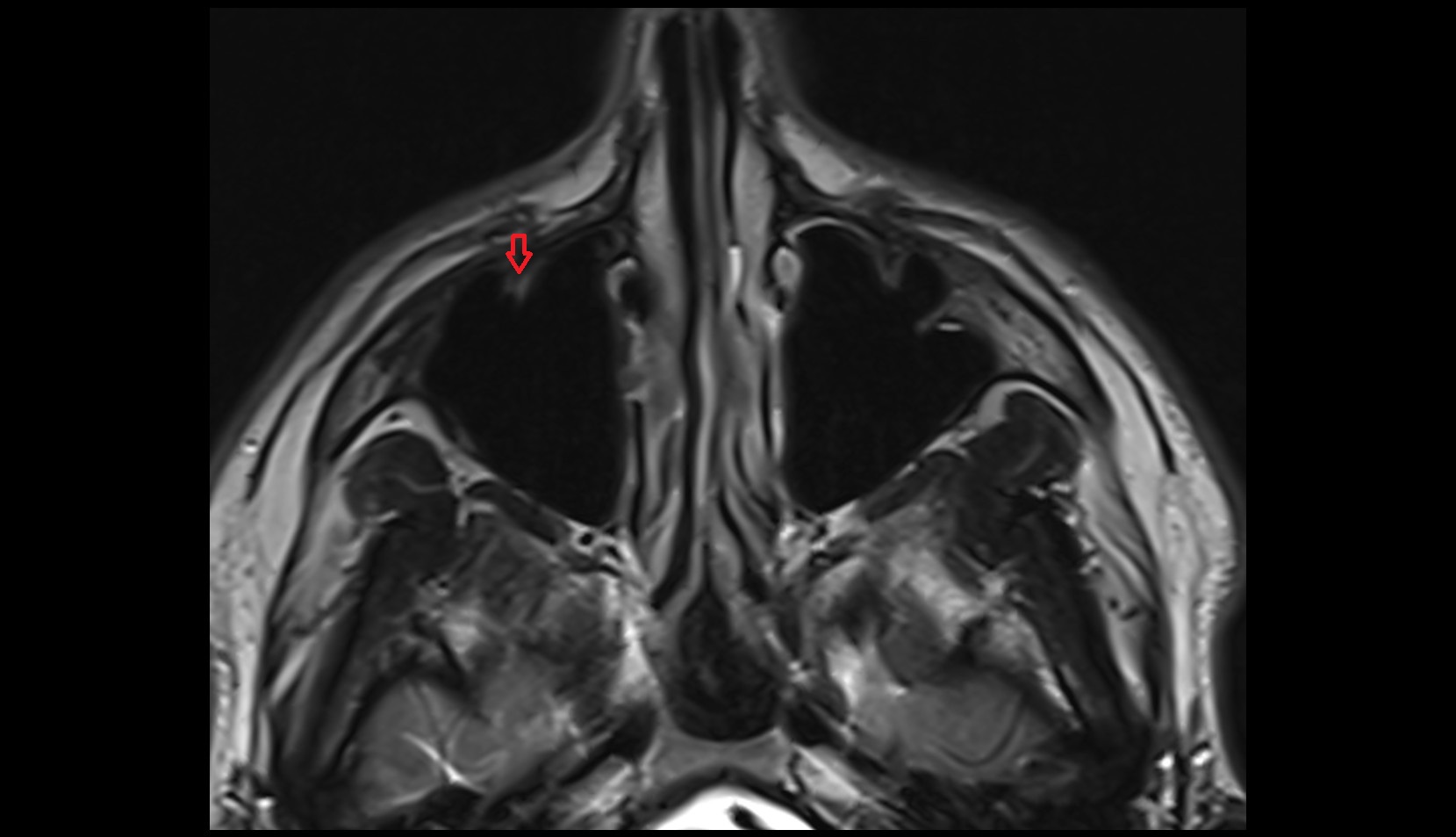 Infraorbital foramen mri axial image 1