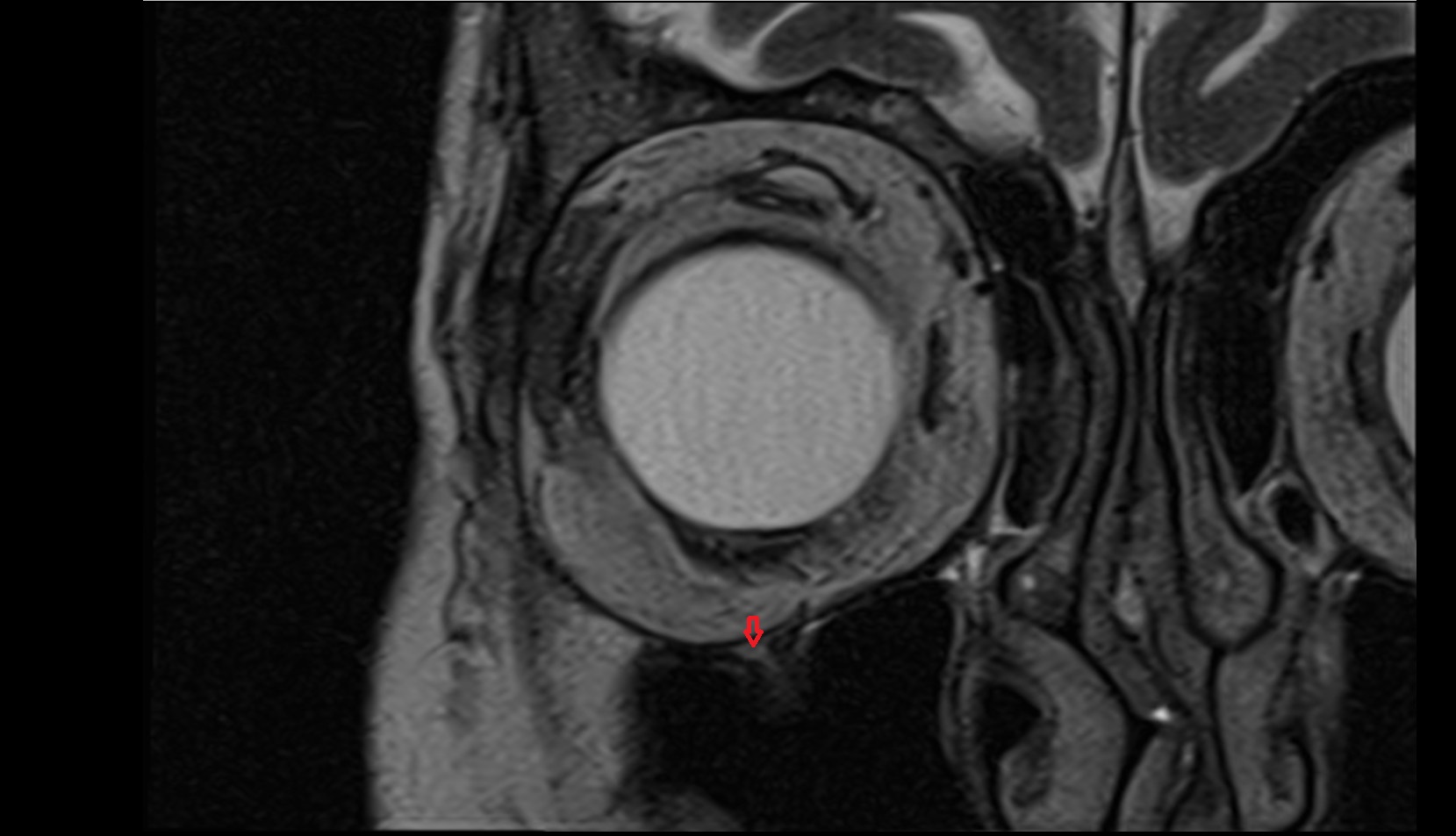 Infraorbital nerve mri image
