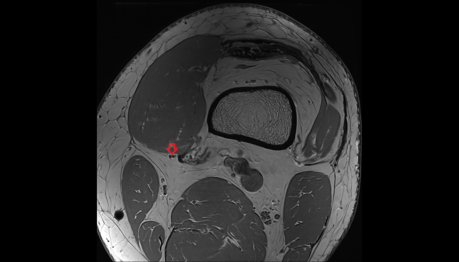 Infrapatellar branch of saphenous nerve axial  cross sectional anatomy 3T MRI AI enhanced  radiology  anatomy image-img-00000-00000