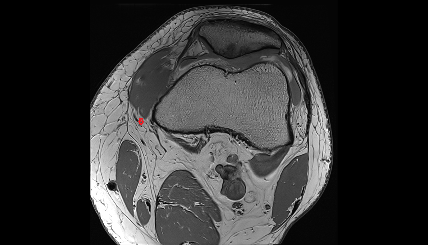 Infrapatellar branch of saphenous nerve axial  cross sectional anatomy 3T MRI AI enhanced  radiology  anatomy image-img-00000-00000_00001
