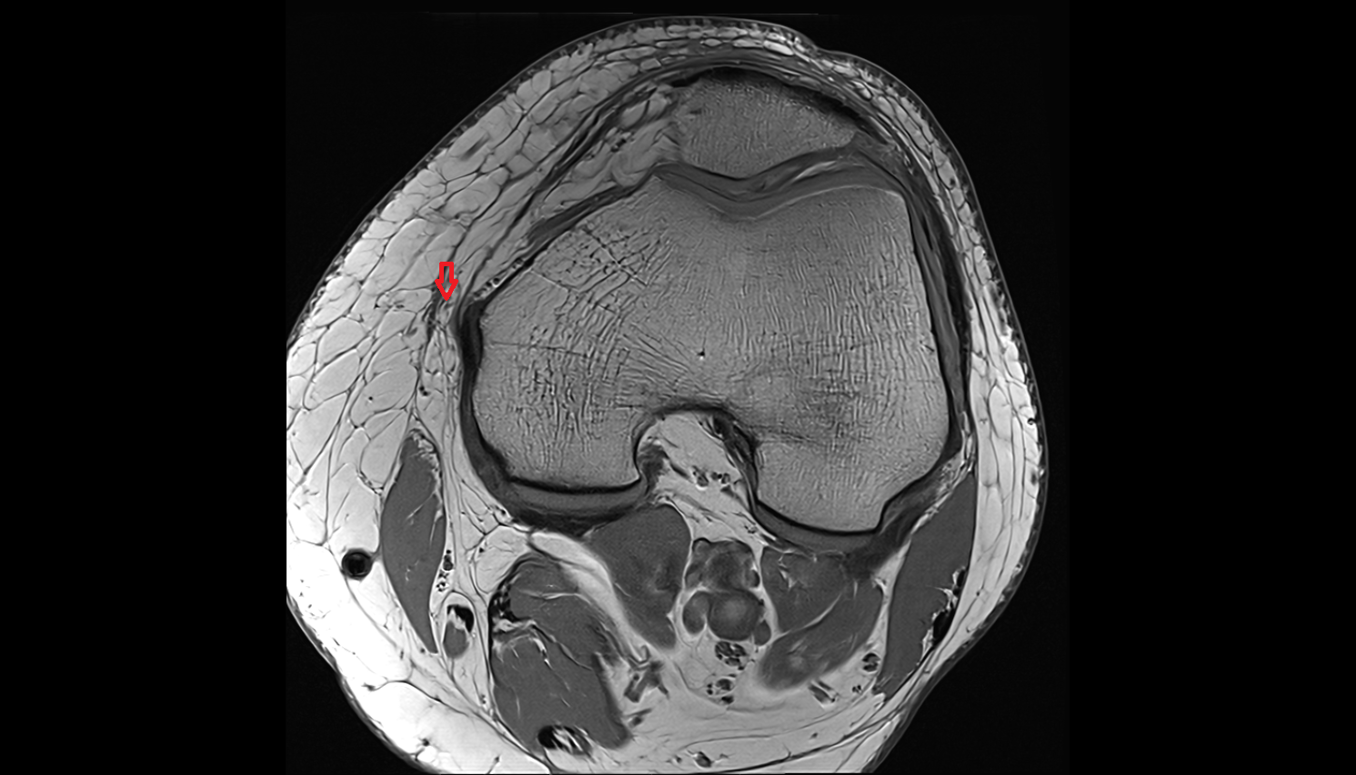Infrapatellar branch of saphenous nerve axial  cross sectional anatomy 3T MRI AI enhanced  radiology  anatomy image-img-00000-00000_00002