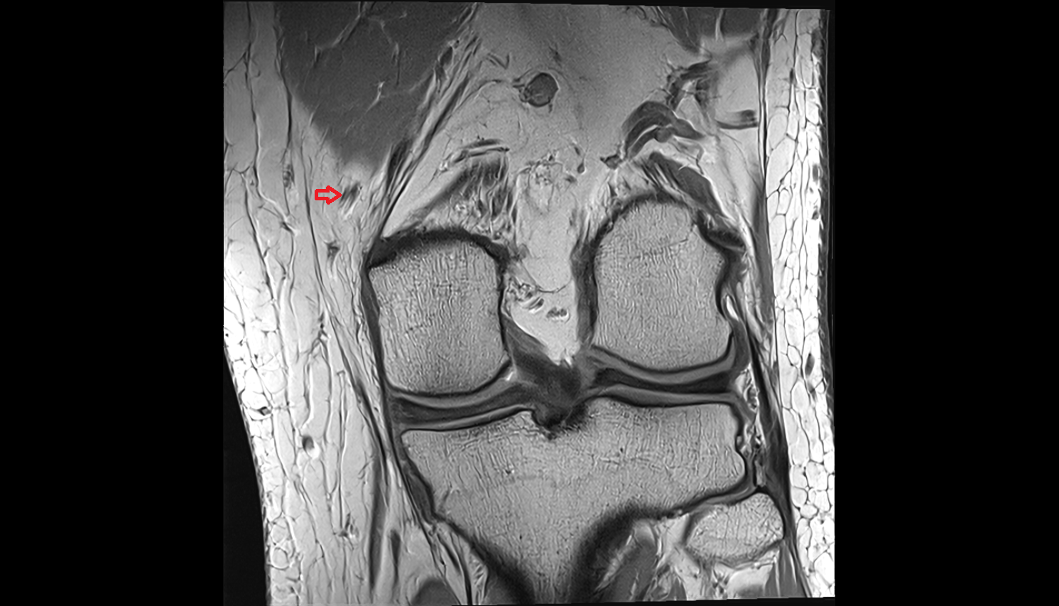 Infrapatellar branch of saphenous nerve coronal  cross sectional anatomy 3T MRI AI enhanced  radiology  anatomy image-img-00000-00000