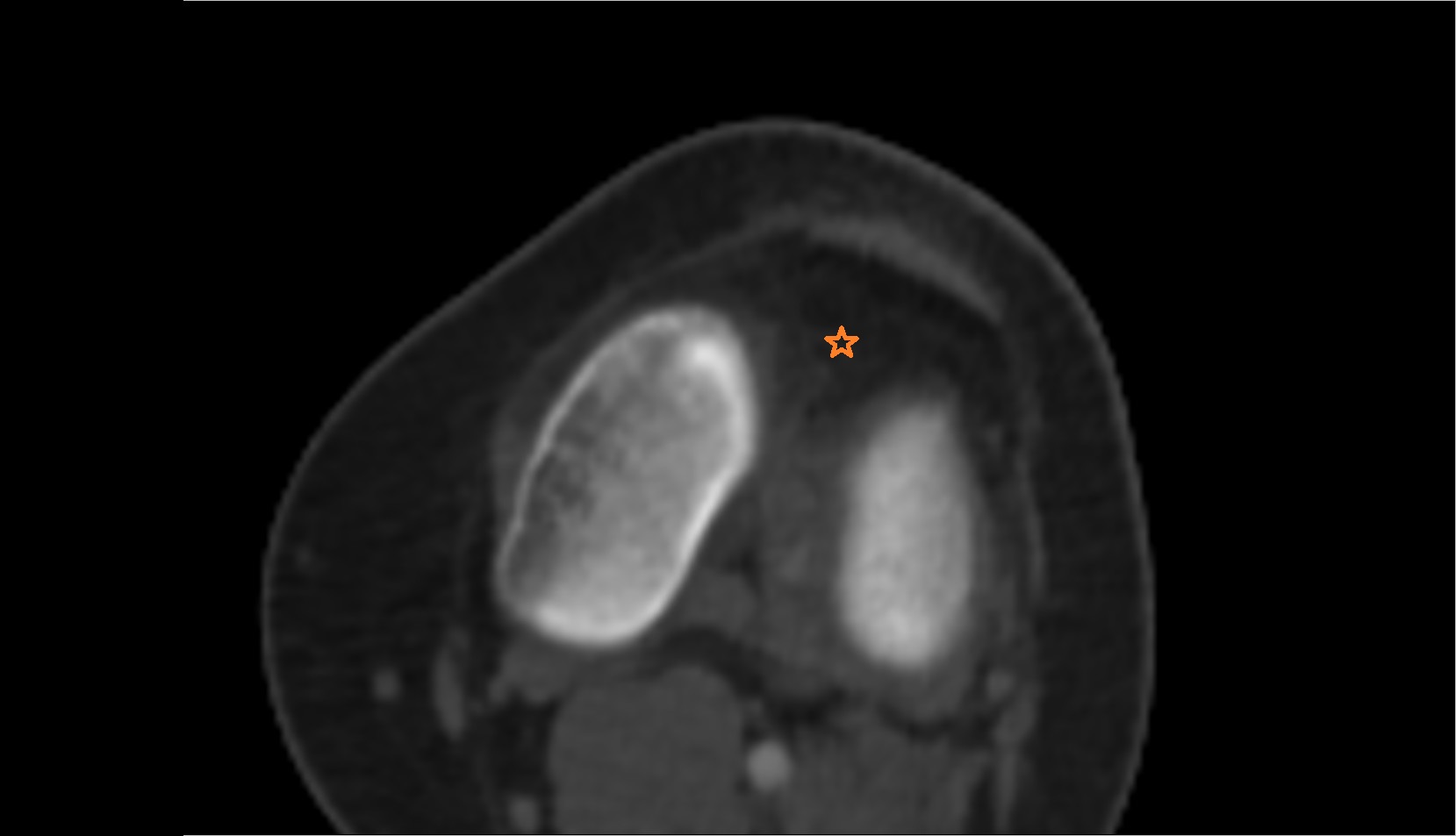 Infrapatellar fat pad (Hoffa’s fat pad) axial ct