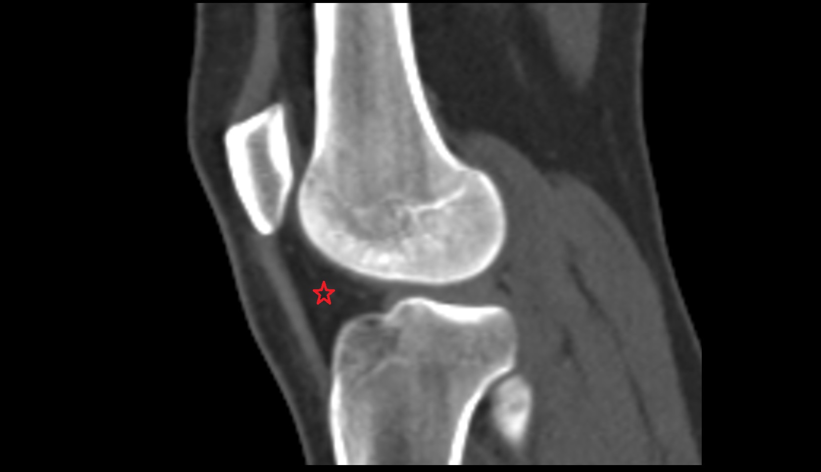 Infrapatellar fat pad (Hoffa’s fat pad) sag ct image