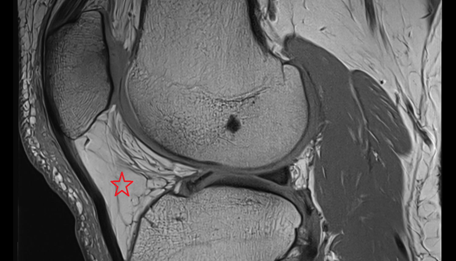Infrapatellar fat pad (Hoffa’s fat pad) sagittal  cross sectional anatomy 3T MRI AI enhanced  radiology  anatomy image-img-00000-00000