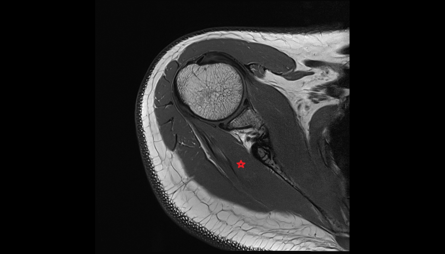 Infraspinatus muscle  anatomy MRI axial  image -img-00000-00000