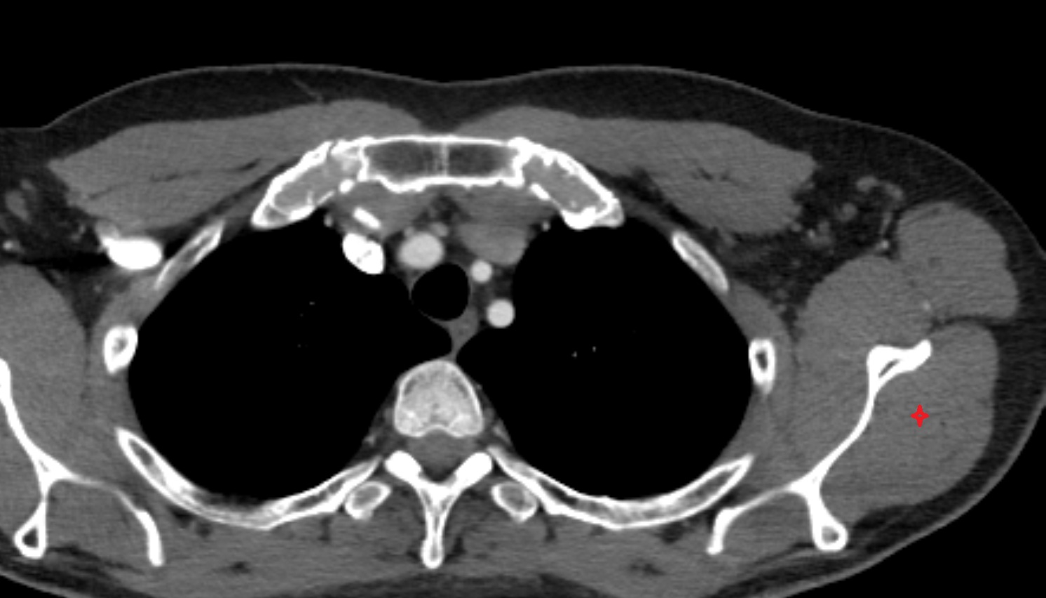 Infraspinatus muscle  anatomy MRI axial  image -img-00000-00000_00001