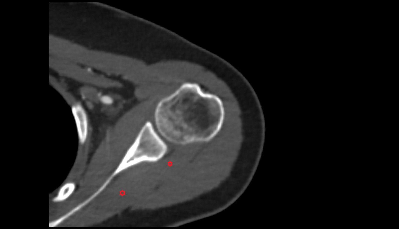 Infraspinatus muscle ct axial