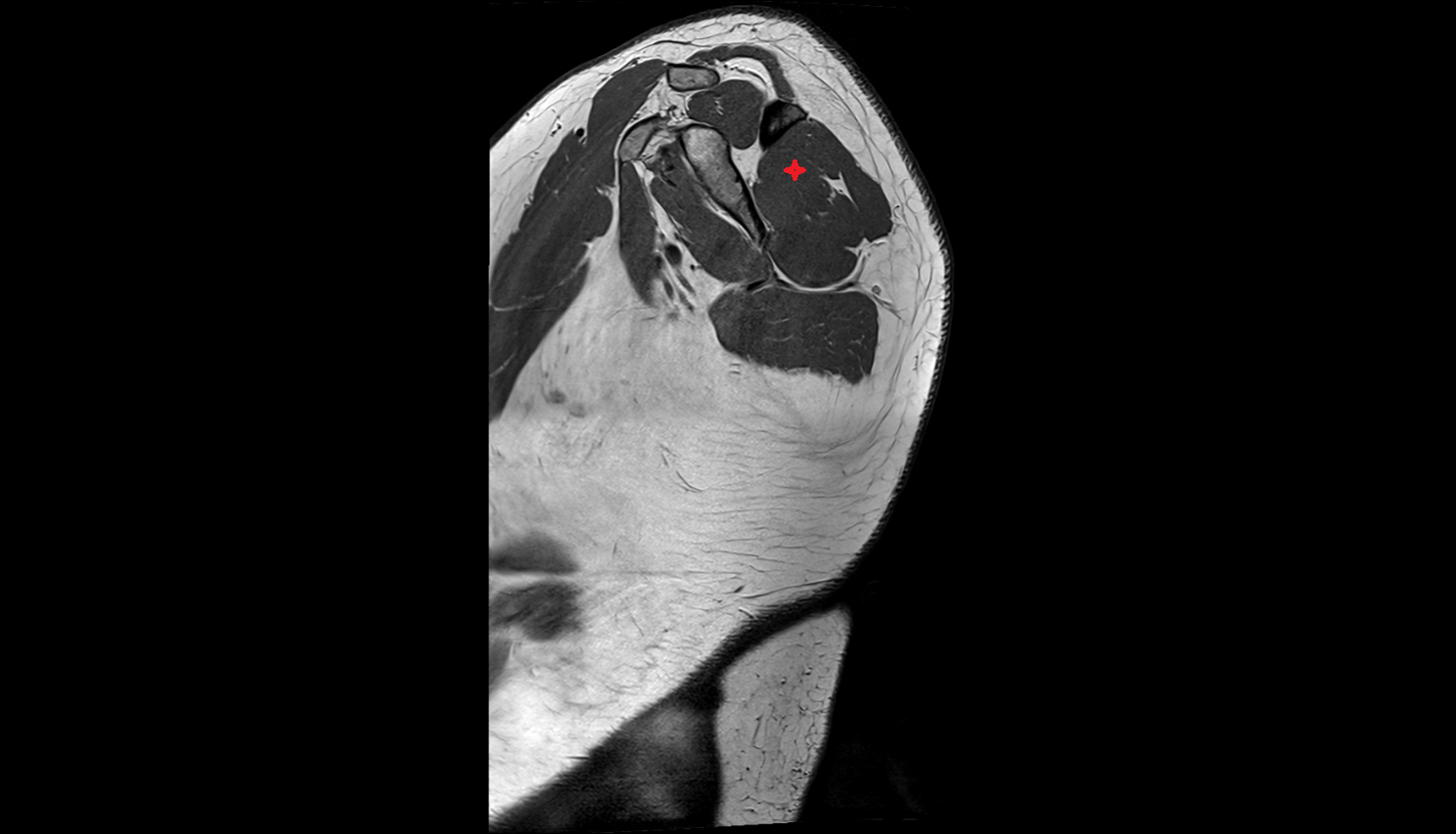 Infraspinatus muscle  sag cross sectional anatomy 3T MRI AI enhanced radiology image-img-00000-00000