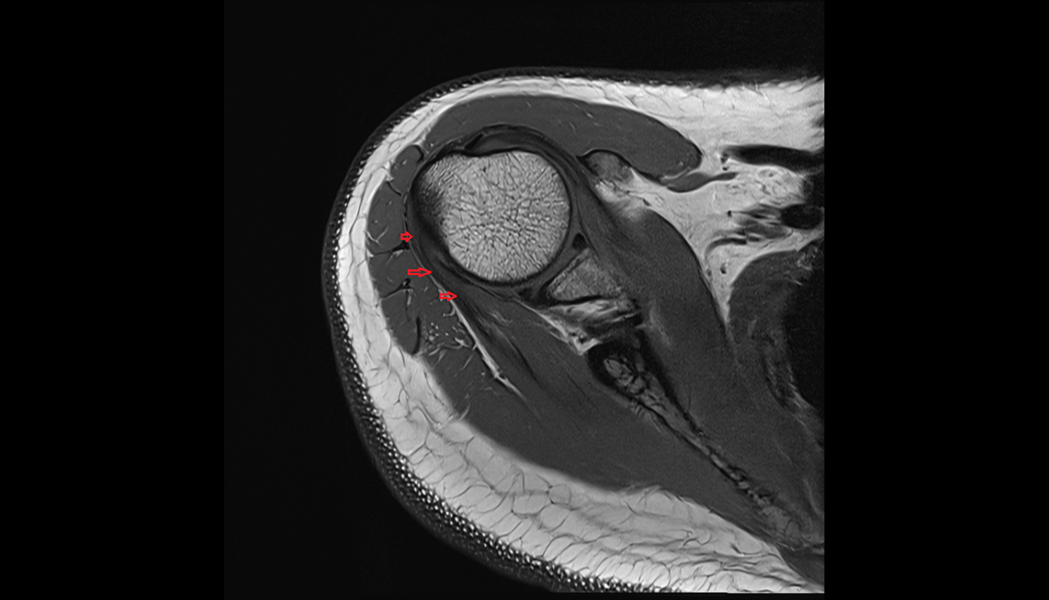 Infraspinatus tendon axial cross sectional anatomy 3T MRI AI enhanced radiology image-img-00000-00000