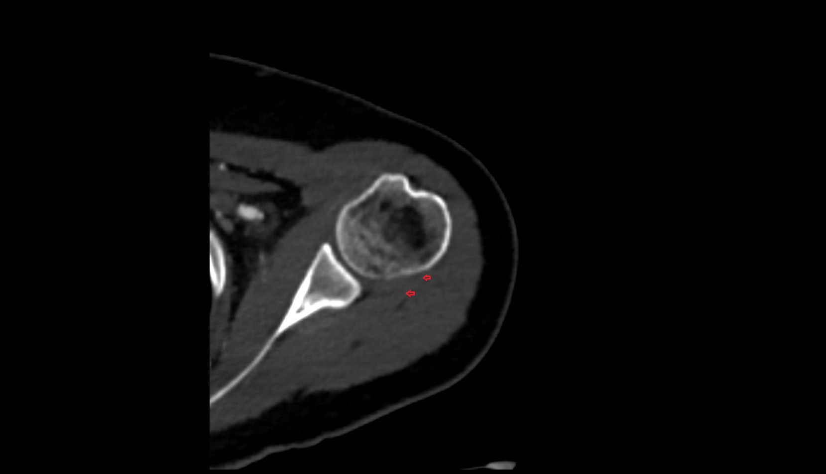 Infraspinatus tendon ct axial