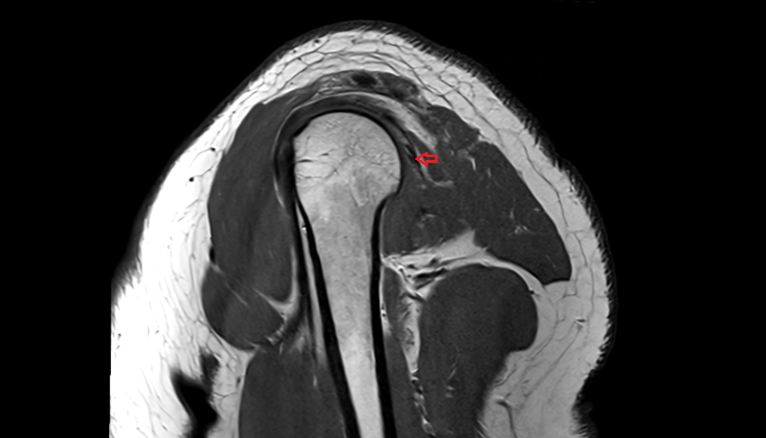 Infraspinatus tendon sag cross sectional anatomy 3T MRI AI enhanced radiology image-img-00000-00000