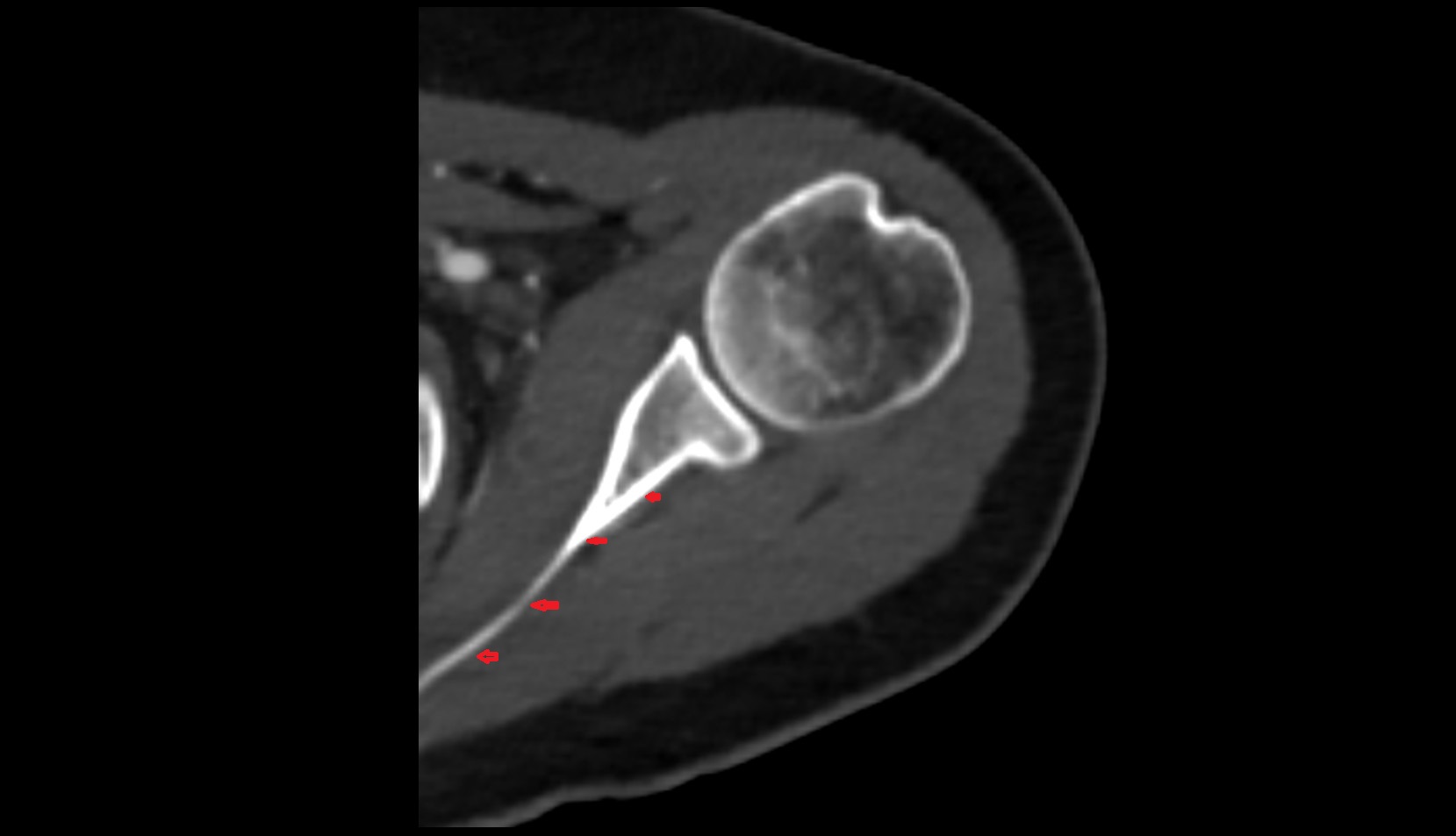Infraspinous fossa ct axial