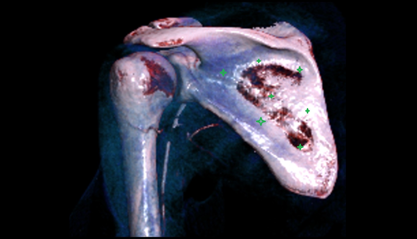 Infraspinous fossa ct vrt image