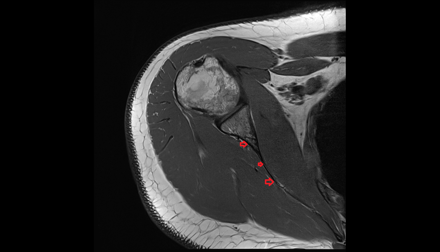 Infraspinous fossa of scapula axial cross sectional anatomy 3T MRI AI enhanced radiology image-img-00000-00000