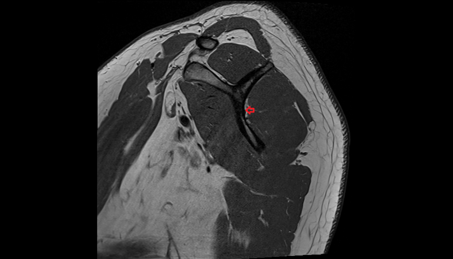 Infraspinous fossa of scapula sag cross sectional anatomy 3T MRI AI enhanced radiology image-img-00000-00000