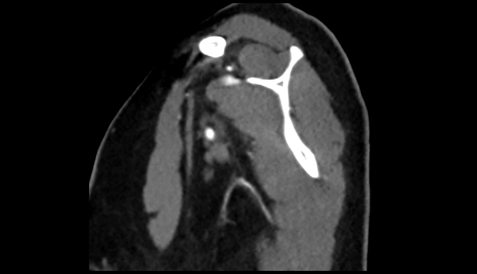 Infraspinous fossa sacpuls sag image
