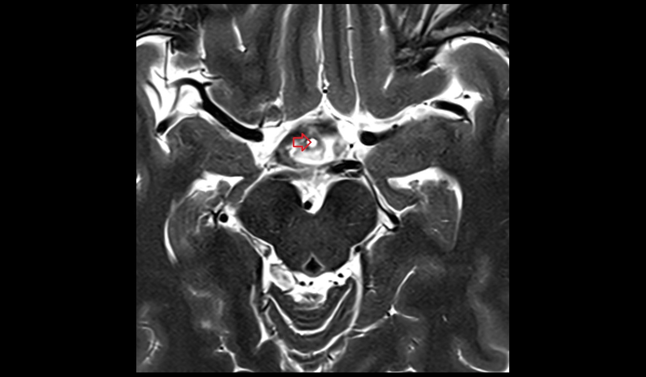 Infundibular recess mri 3t axial image