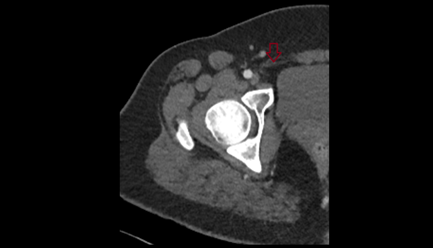 Inguinal ligament CT AXIAL