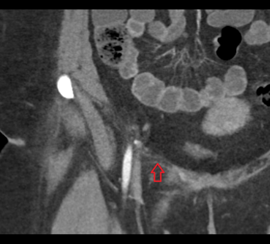 Inguinal ligament  CT coronal  anatomy  image-img-00000-00000