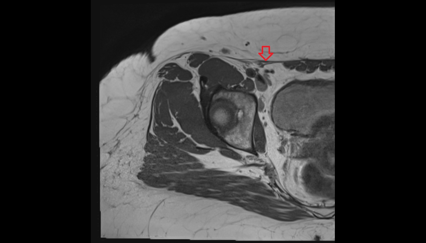 Inguinal ligament   MRI  AXIAL  anatomy  image-img-00000-00000