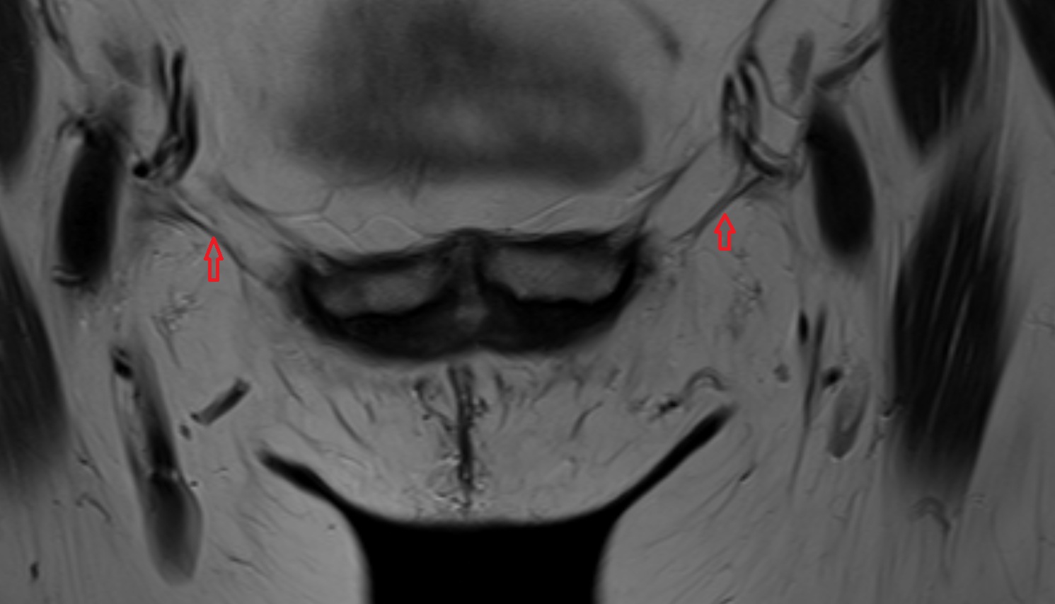 Inguinal ligament   MRI  coronal  anatomy  image-img-00000-00000