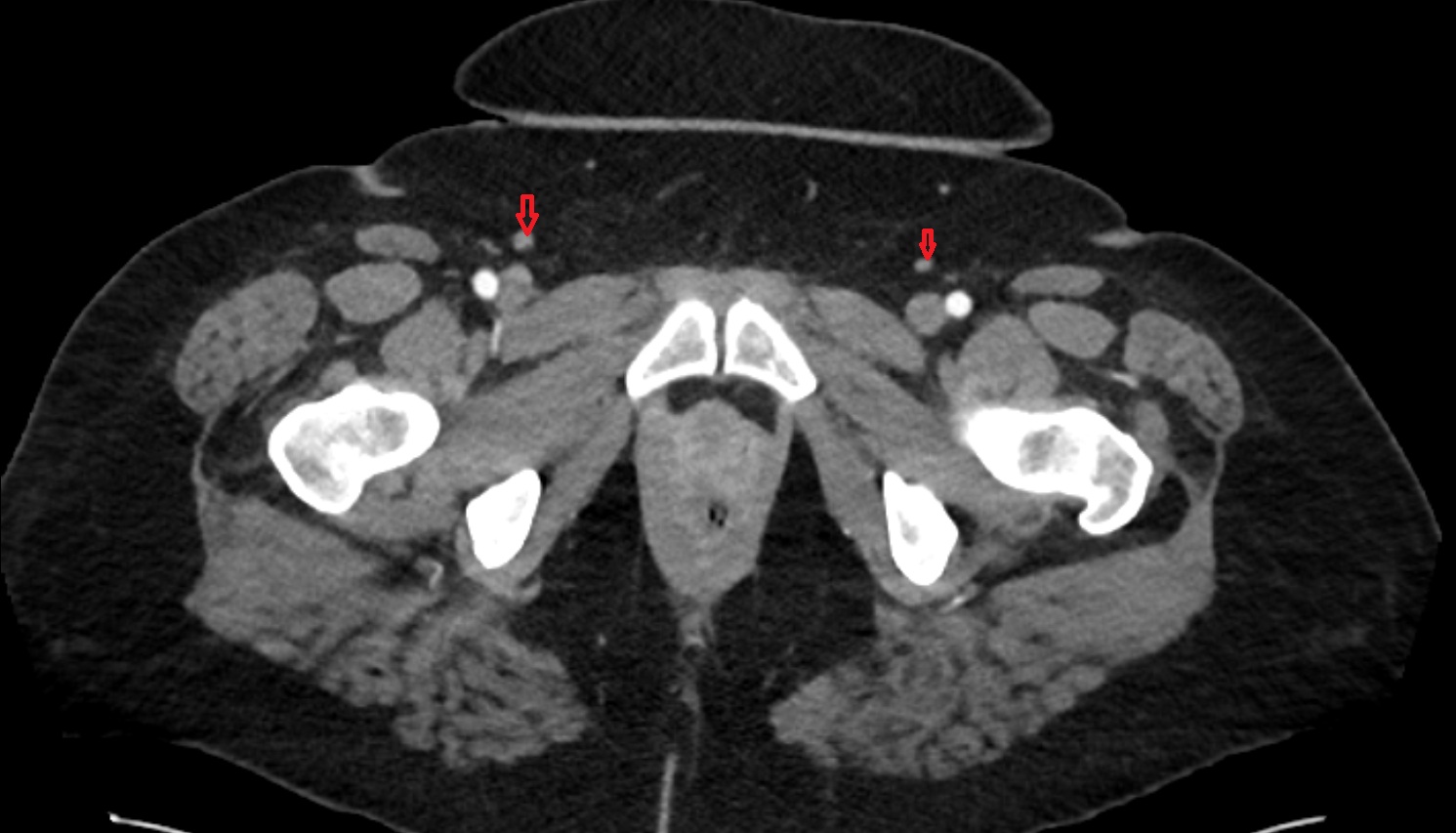 Inguinal lymph nodes  CT axial  anatomy  image-img-00000-00000