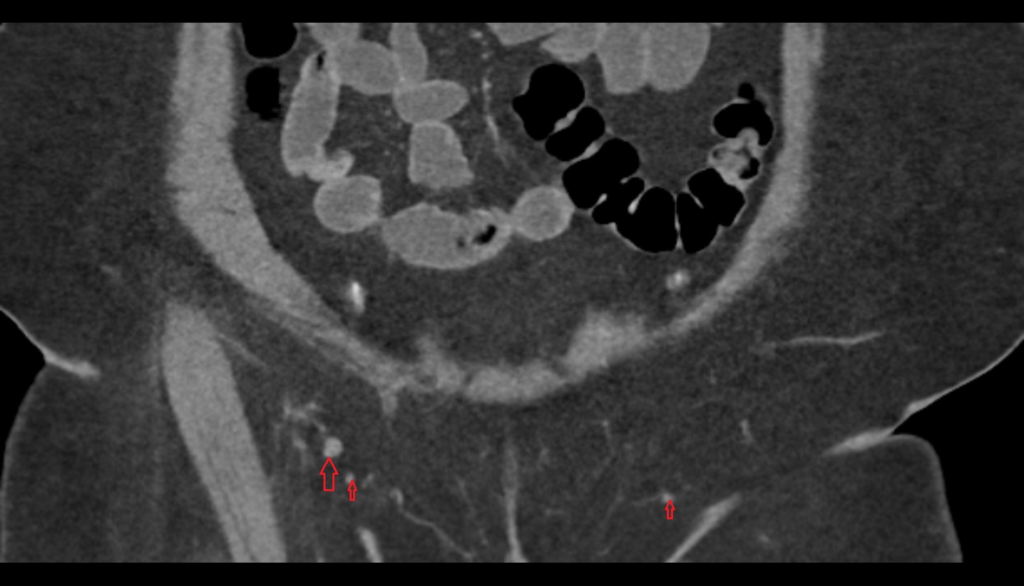 Inguinal lymph nodes  CT coronal  anatomy  image-img-00000-00000