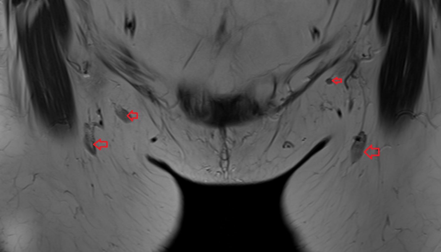 Inguinal lymph nodes  MRI  CORONAL  anatomy  image-img-00000-00000