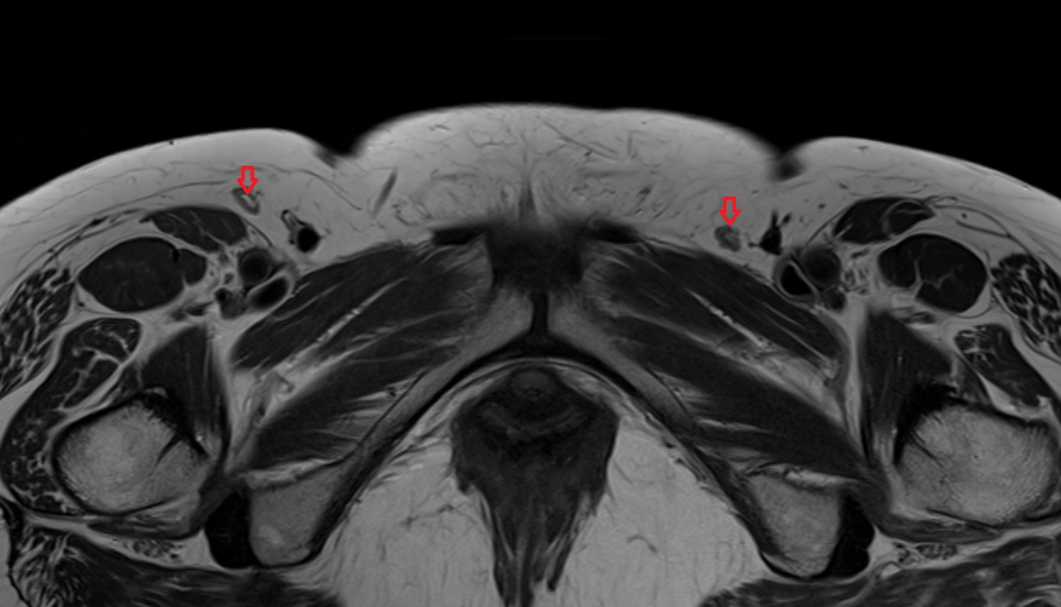Inguinal lymph nodes  MRI  axial  anatomy  image-img-00000-00000