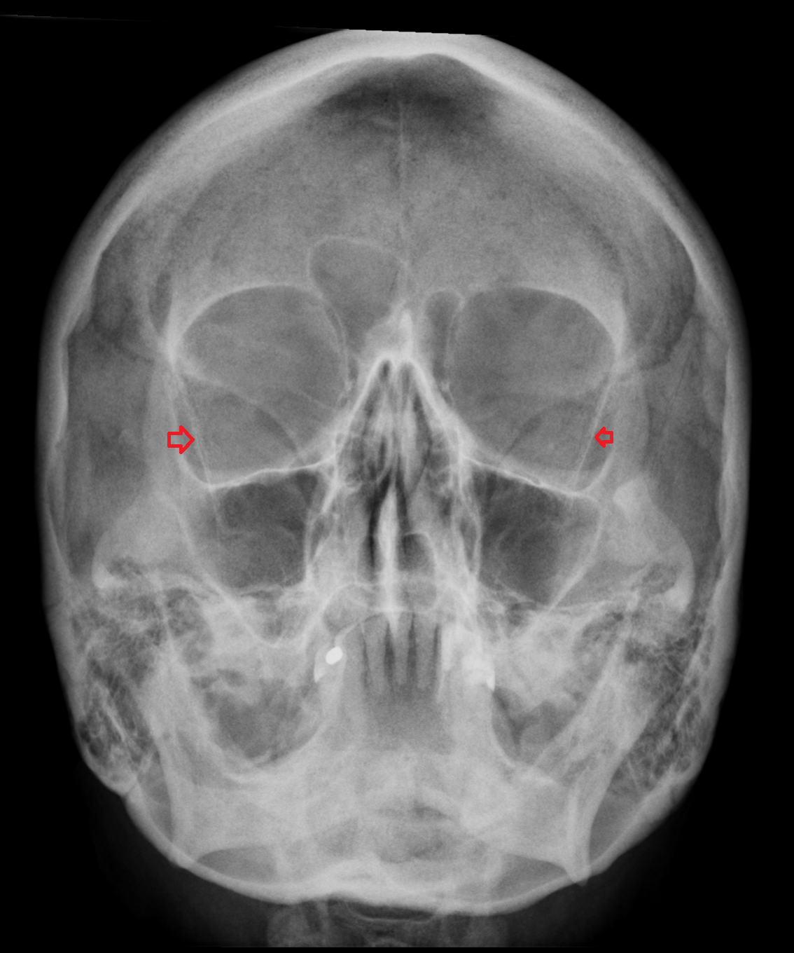 Innominate line (skull) X RAY
