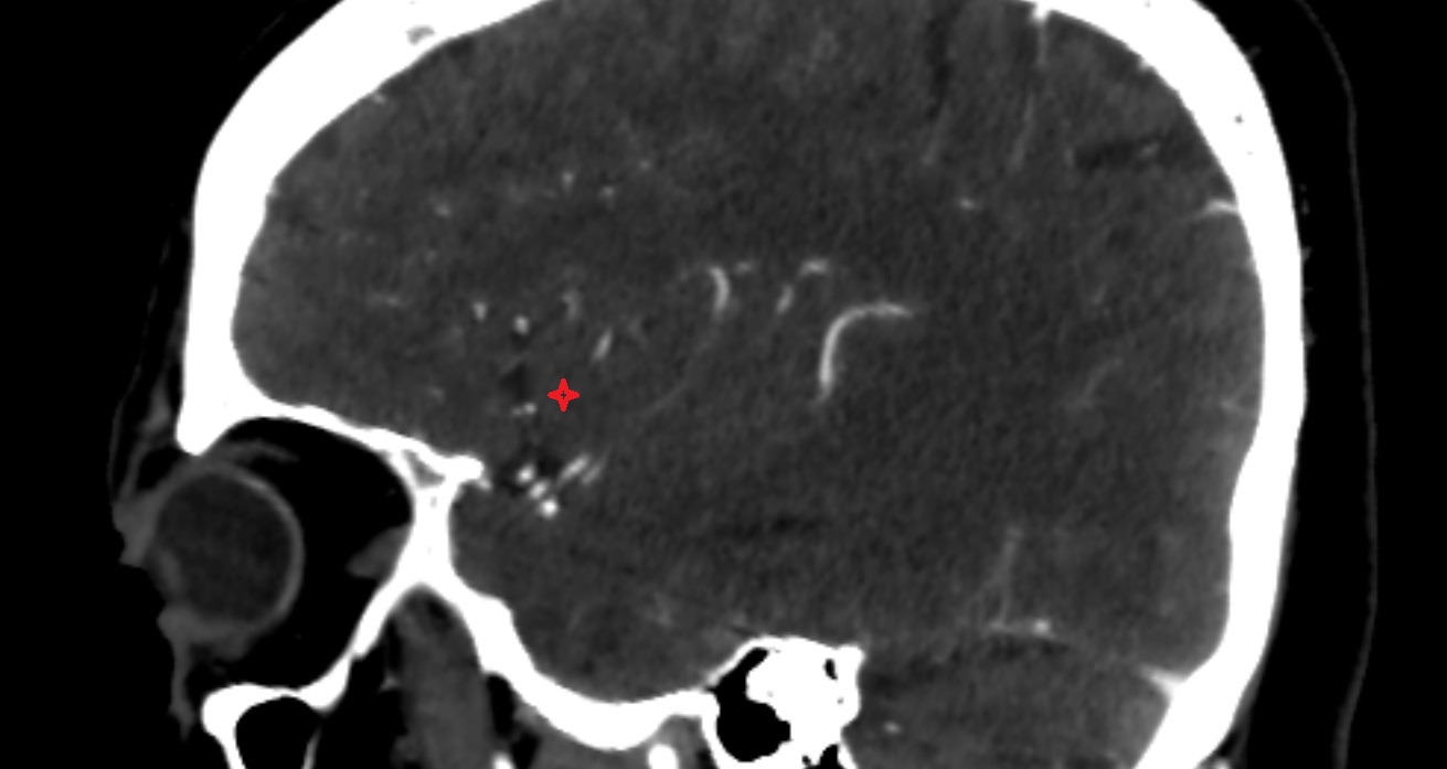 Insular cortex  CT sagittal anatomy image -img-00001-00001