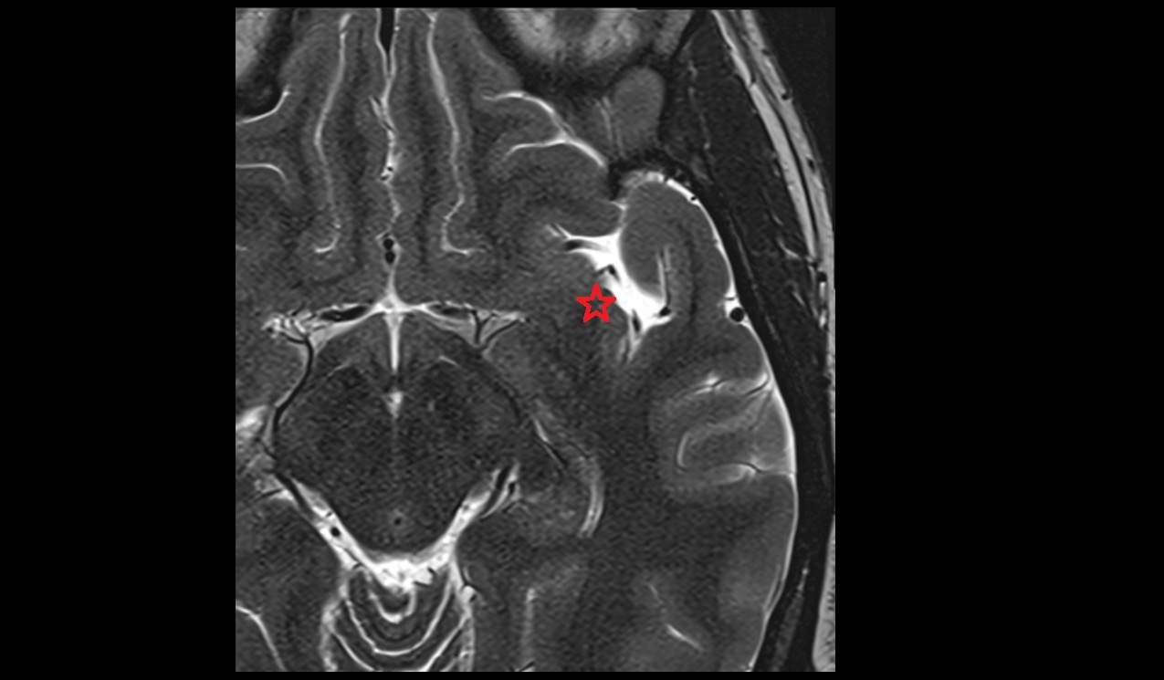 Insular threshold mri 3t axial image