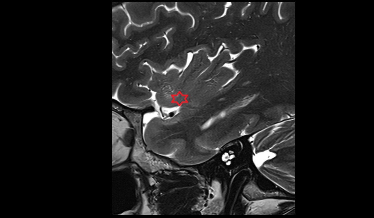 Insular threshold mri 3t sagittal image