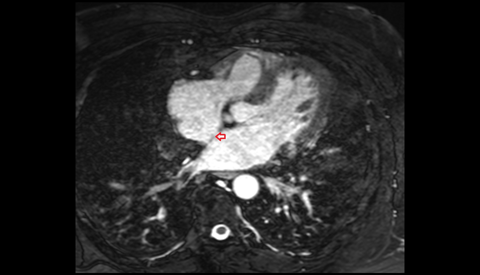 Interatrial septum mri image