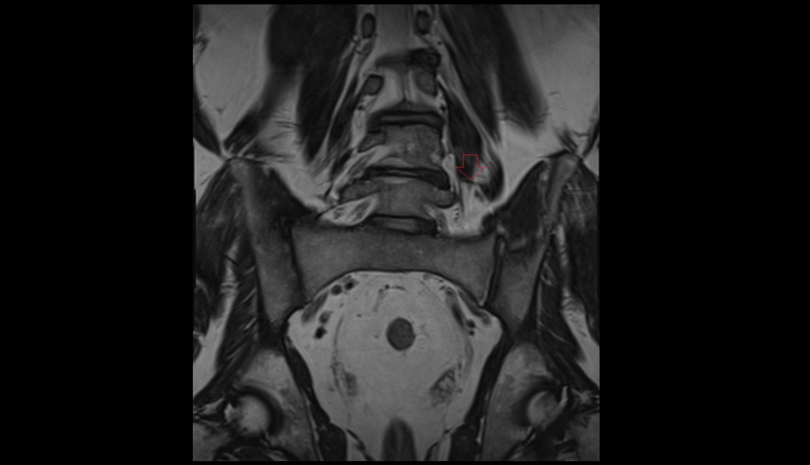 Intercommunicating branches of L3–L4 nerves