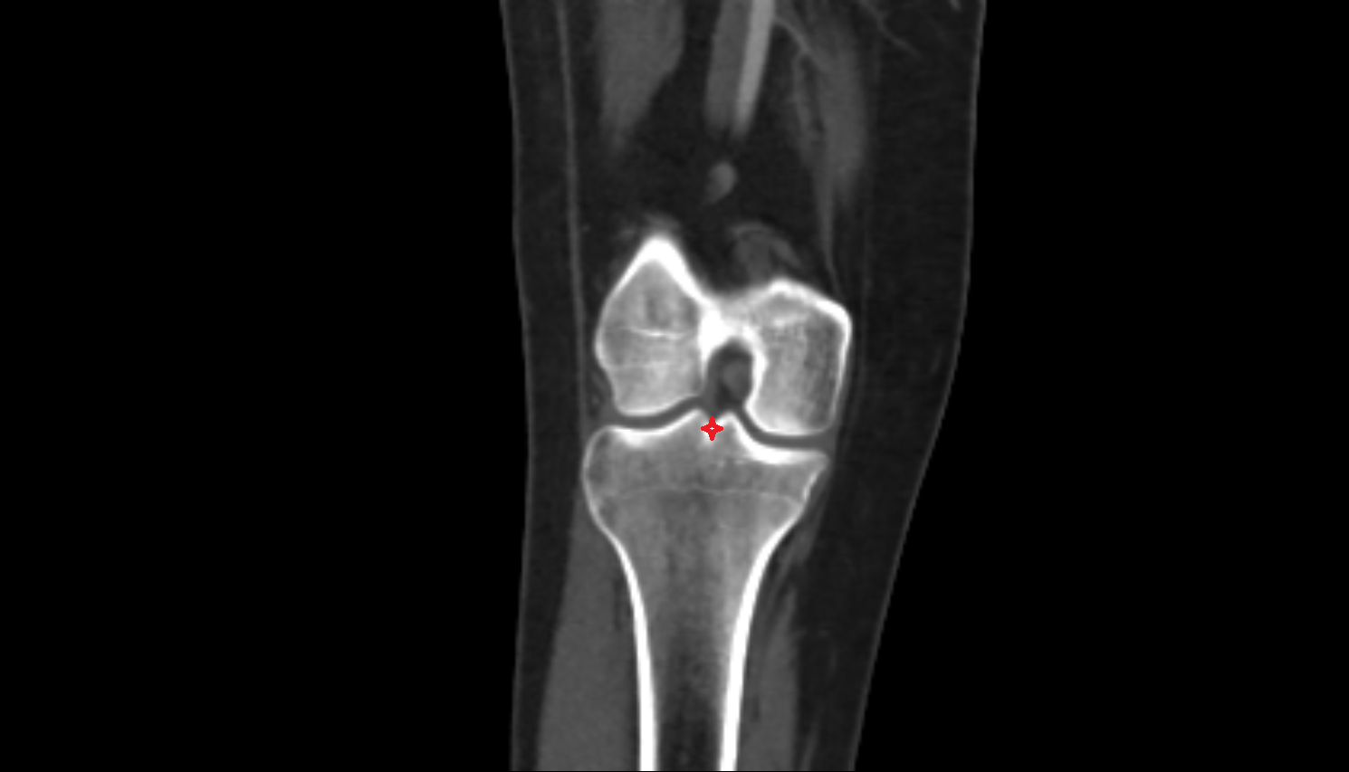 Intercondylar eminence ct anatomy labelled image-img-00000-00000