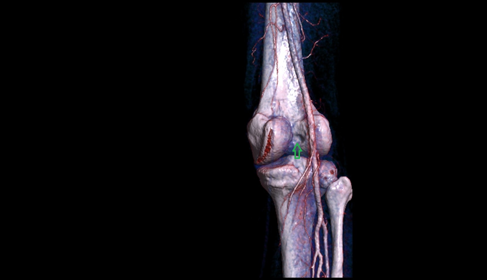 Intercondylar fossa 3d image