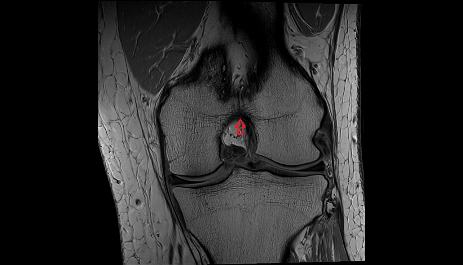Intercondylar fossa  mri  anatomy labelled image-img-00000-00000