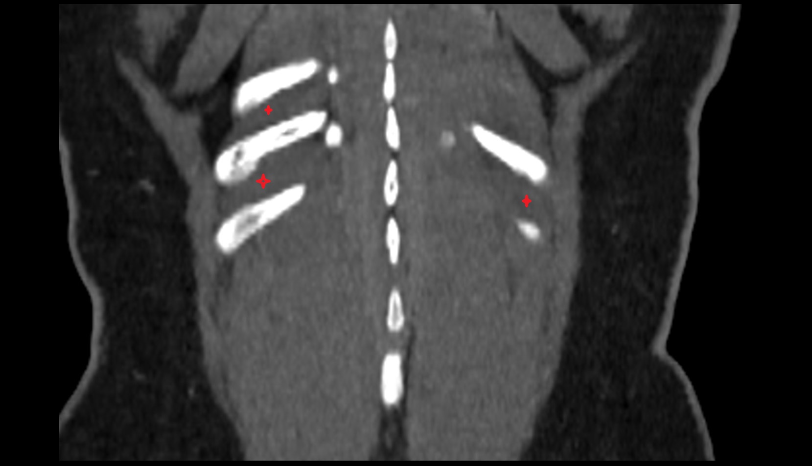 Intercostal muscles CORONAL CT IMAGE