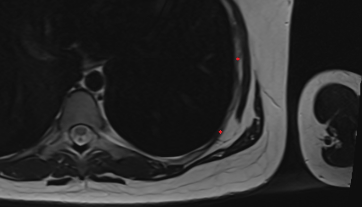 Intercostal muscles  MRI AXIAL  image anatomy  image -img-00000-00000